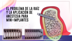 El problema de la raíz y la aplicación de anestesia para mini-implantes