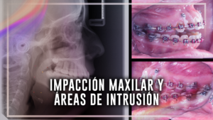 Impacción maxilar y áreas de intrusión