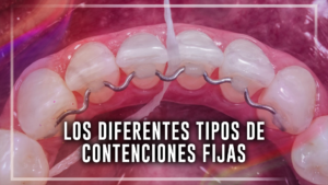 Los diferentes tipos de contenciones fijas