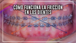 Cómo funciona la fricción en los dientes