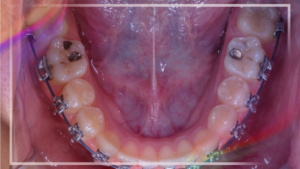 Cómo posicionar mejor el primer molar y qué no hacer para no perjudicar