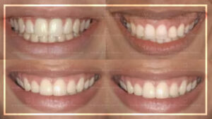 ¿Existe un nivel aceptable de exposición gingival?