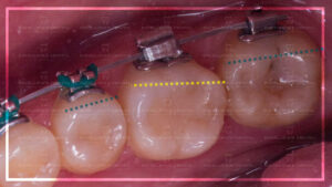 El secreto para colocar el dispositivo accesorio en el 1er molar inferior