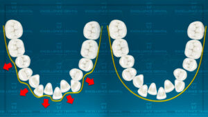 Un secreto para el pegado de brackets de incisivos laterales superiores palatinizados